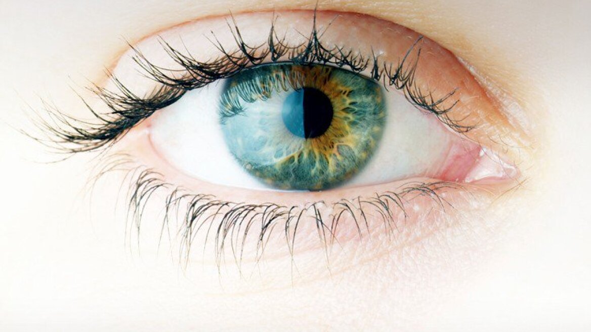 Ανακαλύφθηκαν 112 γονίδια που αυξάνουν τον κίνδυνο για γλαύκωμα στα μάτια