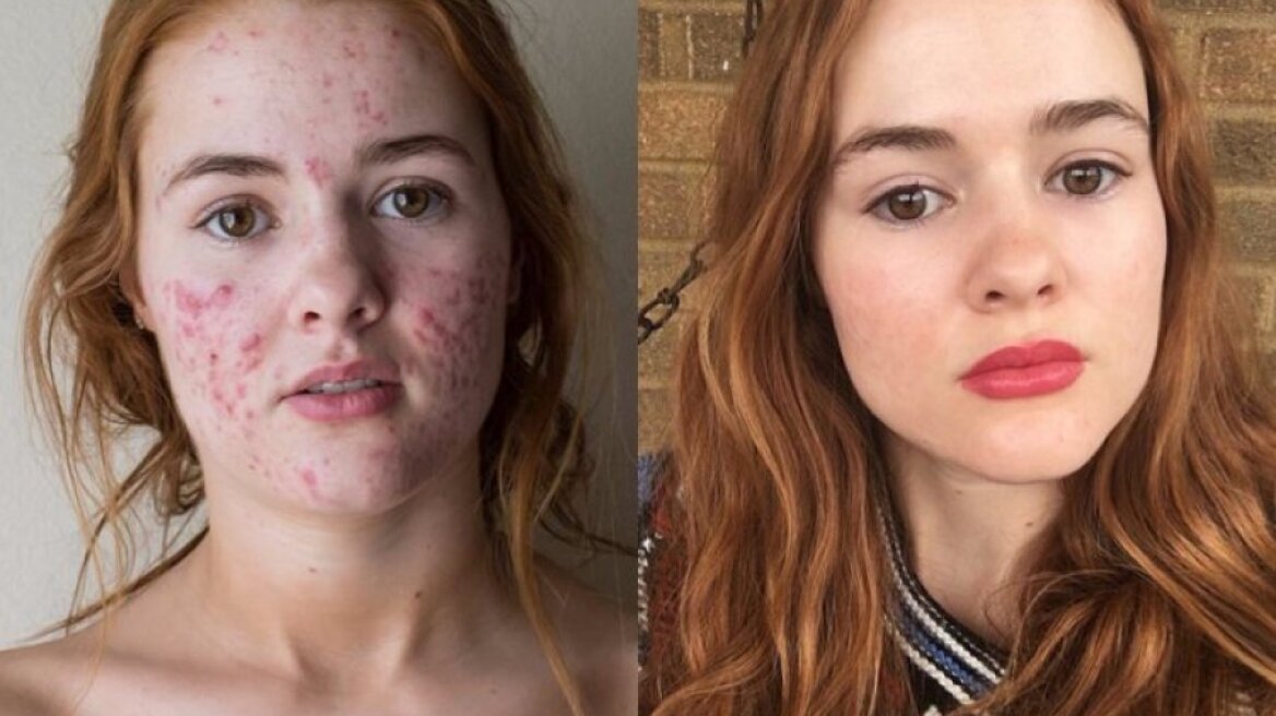 Το σοκαριστικό «πριν» και «μετά» μιας 22χρονης με ακμή