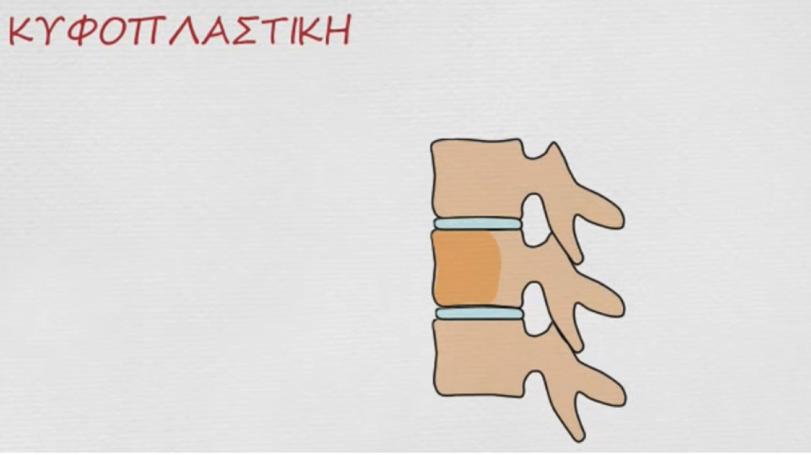 Τι είναι το κάταγμα σπονδυλικής στήλης και γιατί πρέπει να οδηγεί αμέσως στον ορθοπεδικό