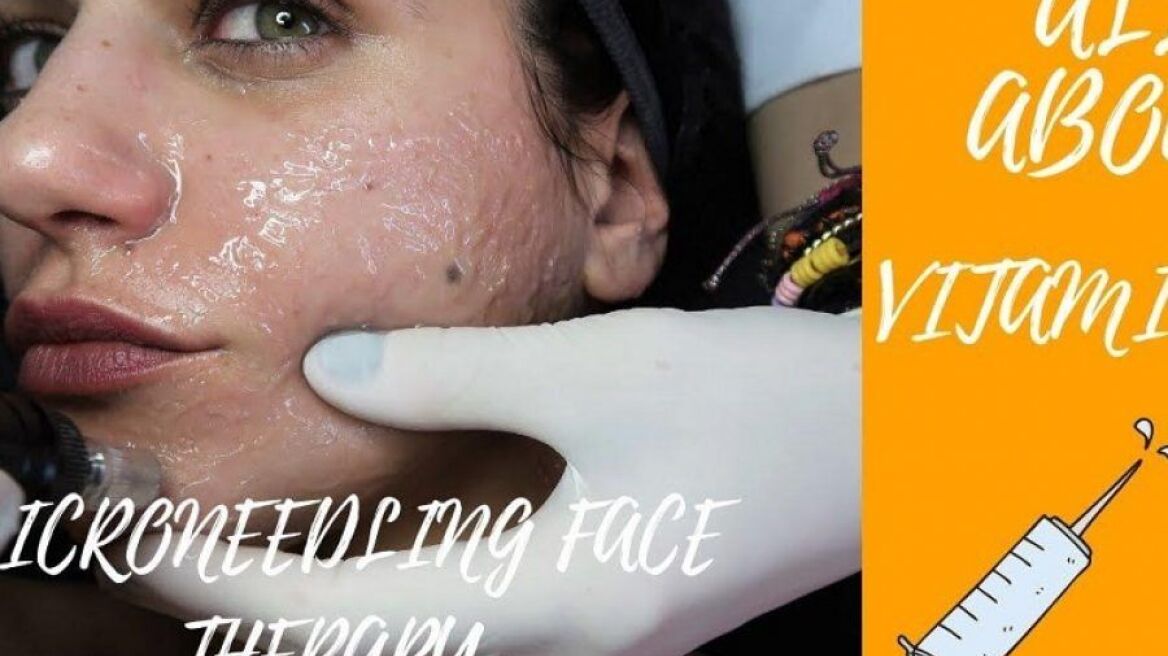 Μεσοθεραπεία Microneedling & Τα πάντα για τη Βιταμίνη C (Video)