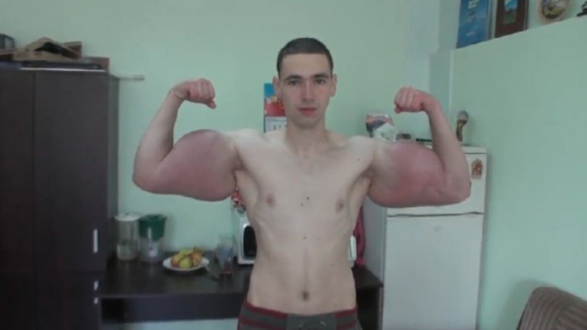 Bodybuilder παραμορφώθηκε από ενέσεις αναβολικών για να μοιάσει στον «Ποπάυ»