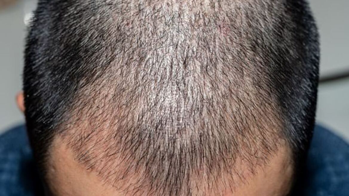 Ινδία: Επιχειρηματίας πέθανε μετά από επέμβαση εμφύτευσης μαλλιών