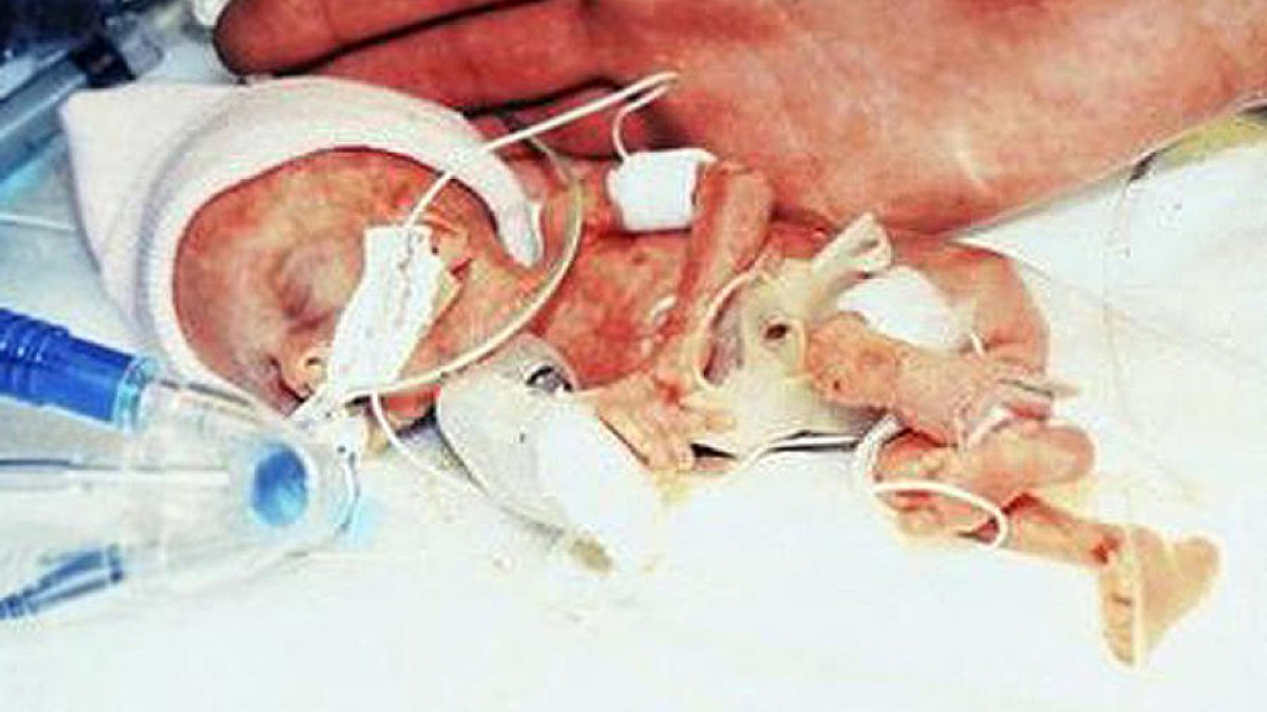 Δείτε πώς είναι σήμερα το μικρότερο μωρό του κόσμου που ζύγιζε 280 γραμμάρια