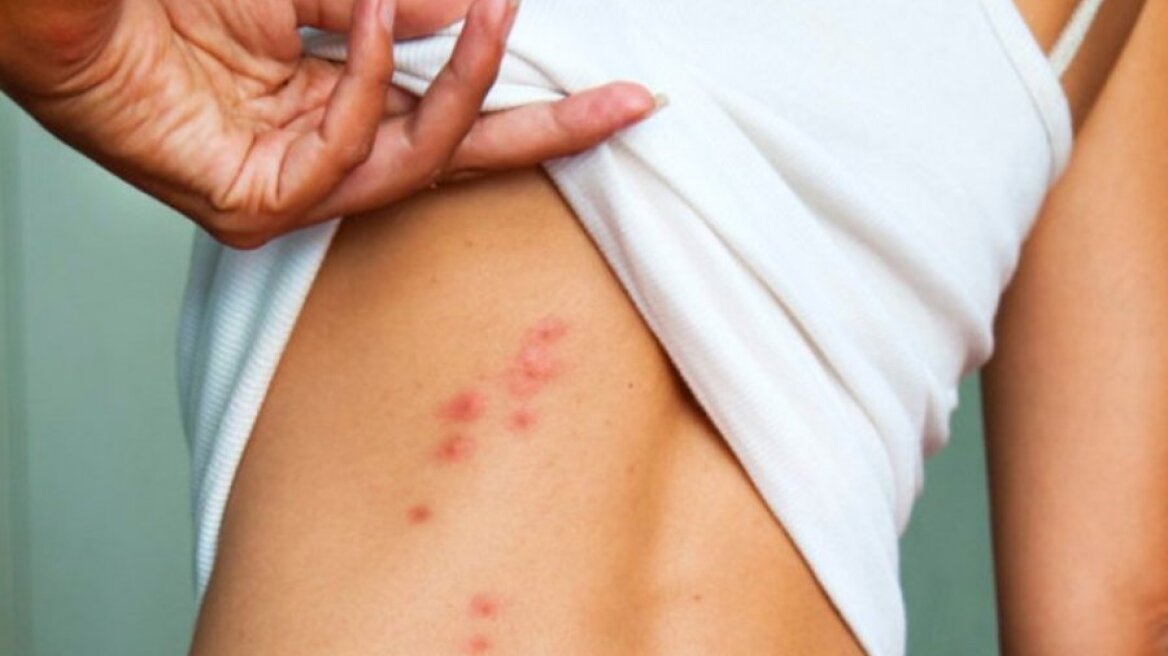 Τα επτά απλά «κόλπα» για να μην σας τσιμπήσει ούτε ένα κουνούπι!