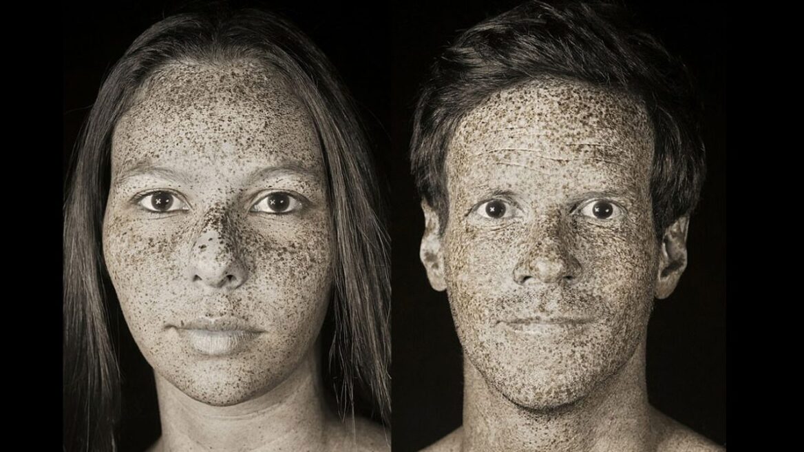 Φωτογραφίες σοκ: Οι βλάβες που προκαλεί ο ήλιος στο δέρμα