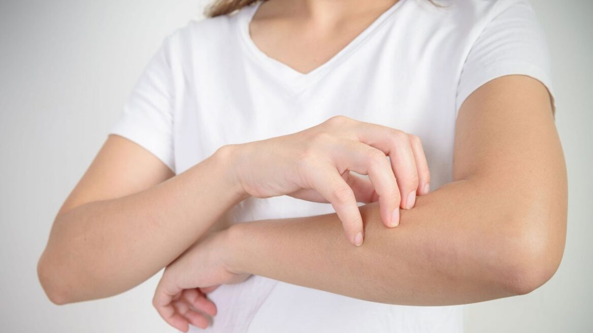 Εγκρίθηκε νέα θεραπεία για την μέτρια έως σοβαρή ψωρίαση