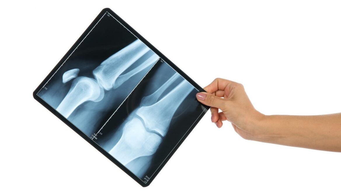 Η οστεοπόρωση αφορά εξίσου άνδρες και γυναίκες