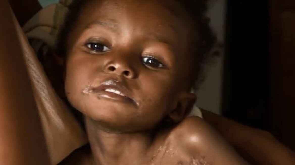 Από πείνα οι μισοί θάνατοι παιδιών στην Αφρική