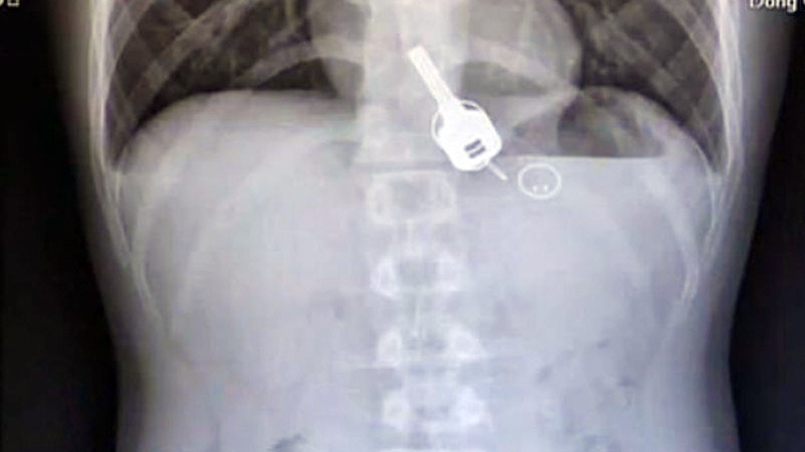 Νόμιζε ότι είχε χάσει τα κλειδιά του αλλά τα είχε καταπιεί δέκα ημέρες πριν το συνειδητοποιήσει 