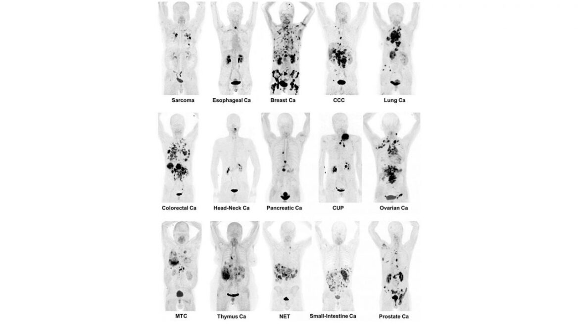 Η εξέταση που εντοπίζει 30 διαφορετικούς καρκίνους