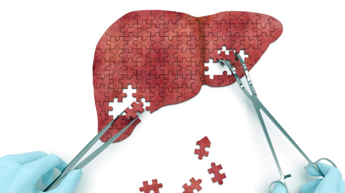 Ιογενείς Ηπατίτιδες: Όγδοη συχνότερη αιτία θανάτου παγκοσμίως