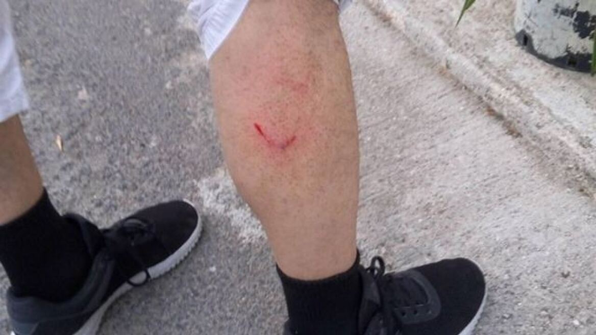 Λαμία: Στο νοσοκομείο 42χρονος μετά από επίθεση αδέσποτων σκύλων