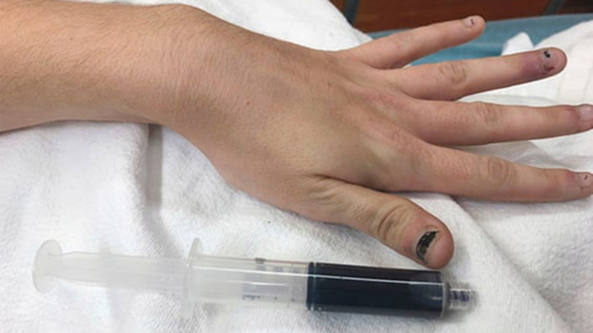 Ιατρικό μυστήριο: Γιατί το αίμα αυτής της γυναίκας είναι μπλε;