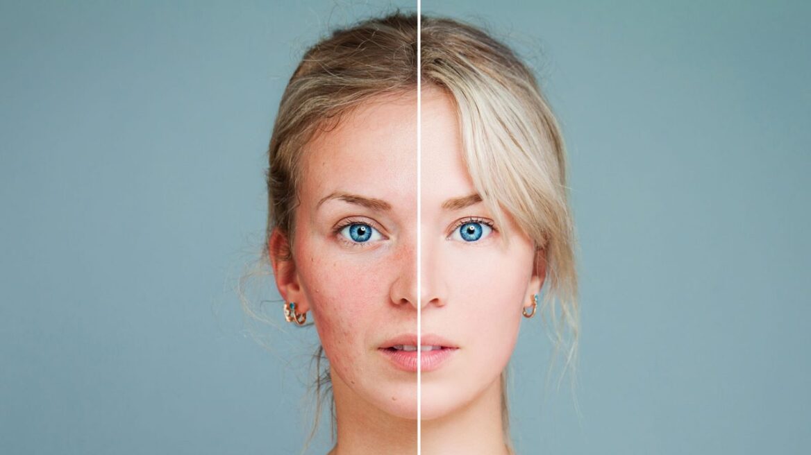 Εφηβική ακμή: Είναι φυσιολογική λέει νέα έρευνα