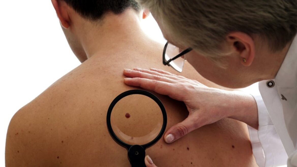 Έρευνα: Γιατί το σολάριουμ απειλεί με καρκίνο του δέρματος τους ομοφυλόφιλους στις ΗΠΑ