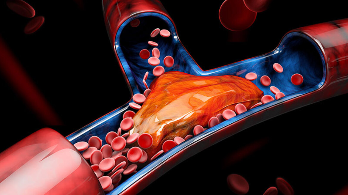 Θρομβοκυττάρωση: Η επικίνδυνη αύξηση των αιμοπεταλίων και πώς αντιμετωπίζεται