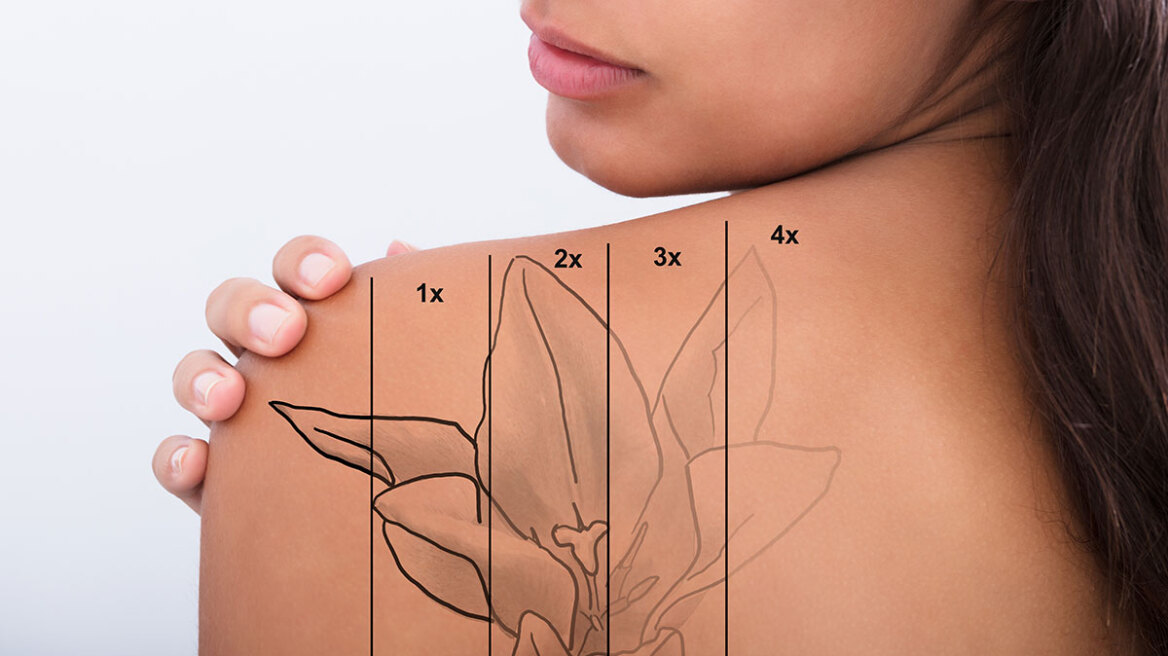 Τατουάζ: Η τεχνική που το σβήνει χωρίς ουλές και δυσχρωμίες