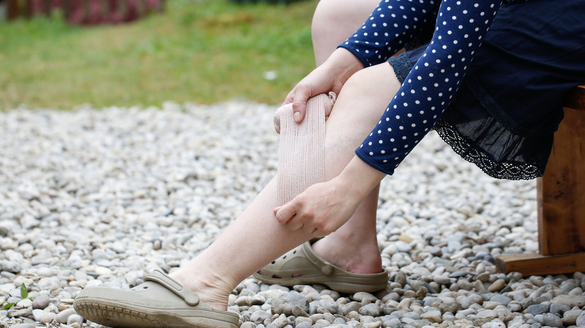 Πώς θεραπεύονται οι κιρσοί