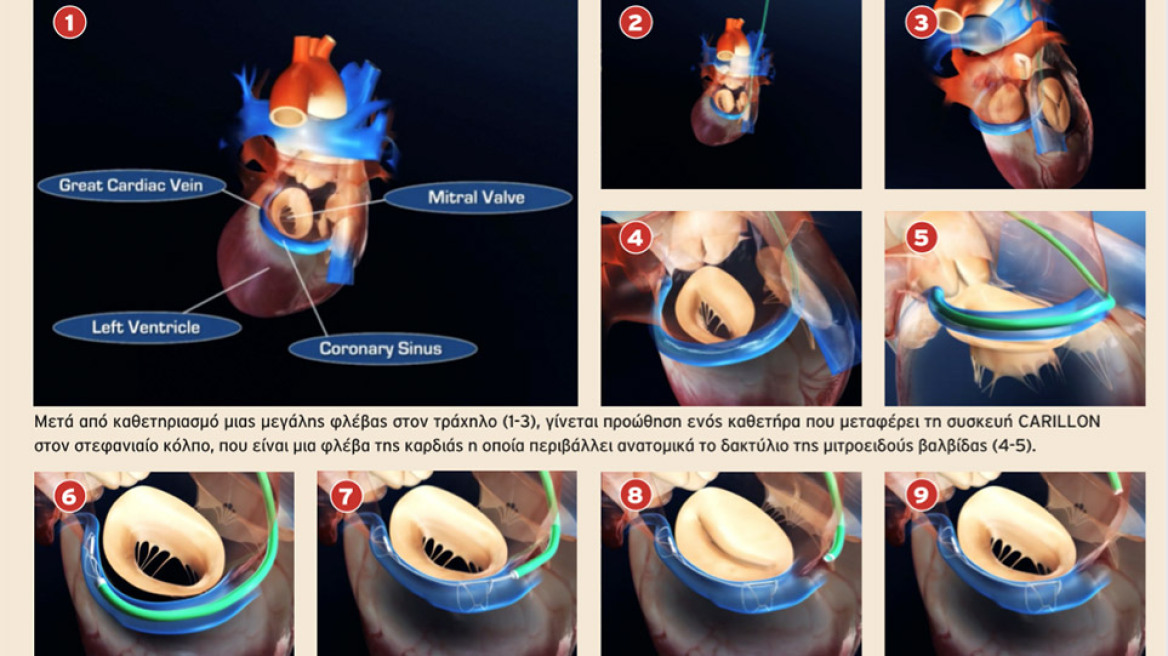 Metropolitan Hospital: πρωτοποριακή, διαδερμική μέθοδος για την επιδιόρθωση ανεπάρκειας της μιτροειδούς βαλβίδας