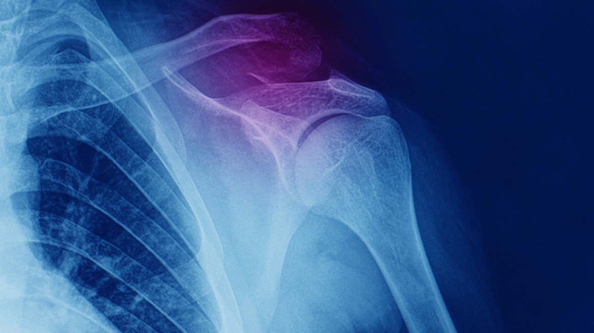 Οστεοπορωτικά κατάγματα: Η «μάστιγα» του 21ου αιώνα