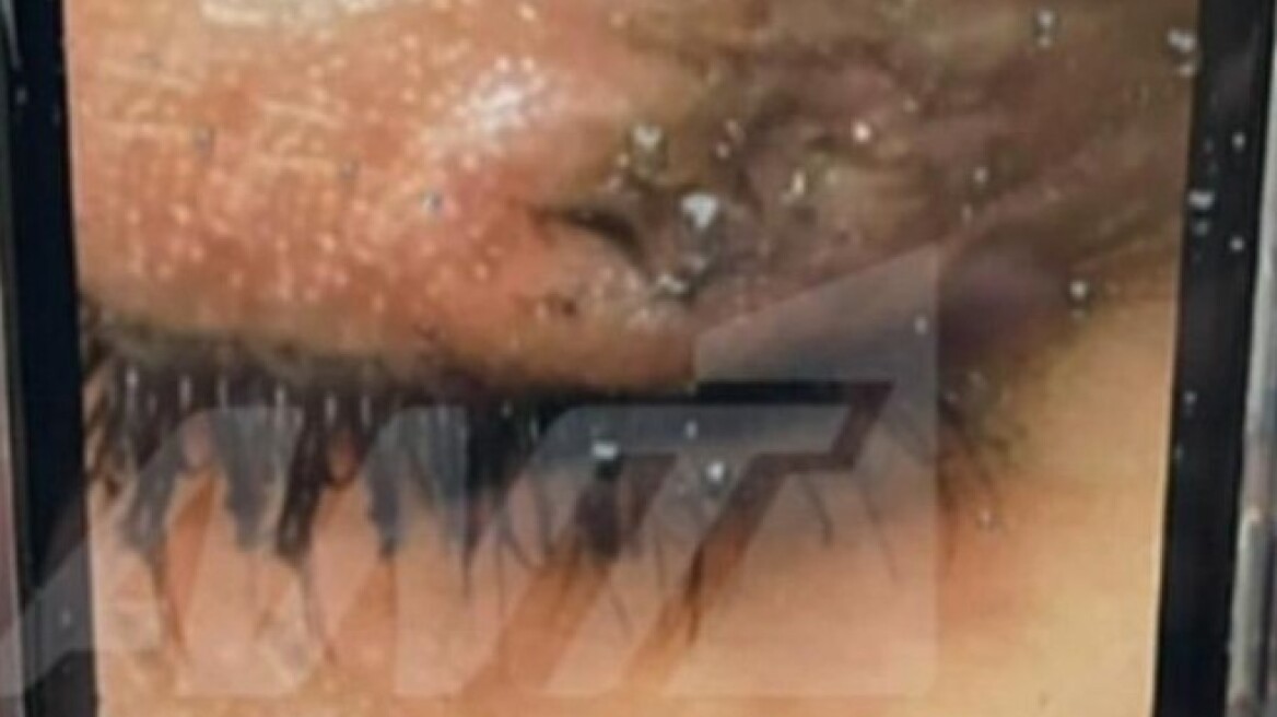 Συνελήφθη η 16χρονη που έσβησε τσιγάρο στο μάτι συμμαθήτριάς της - Σοκάρει η φωτογραφία