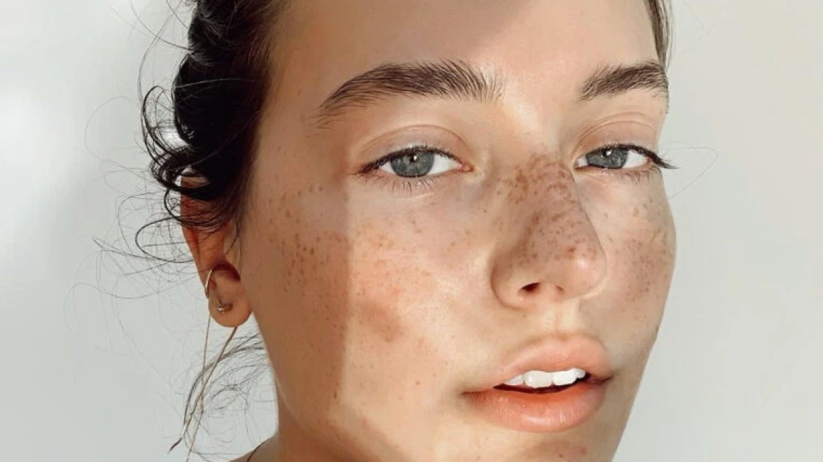 Κυστική ακμή: Όλα όσα πρέπει να γνωρίζετε για να την αντιμετωπίσετε αποτελεσματικά