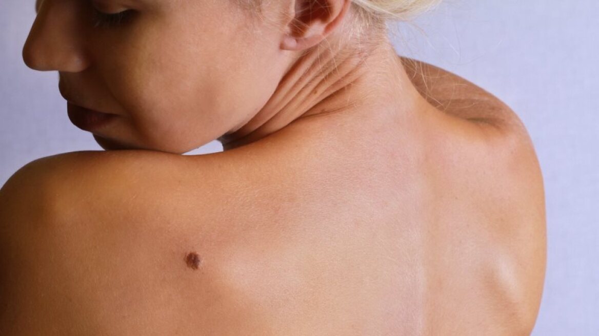 Κακόηθες μελάνωμα: Οι θεραπευτικές επιλογές που βελτιώνουν τη ζωή των ασθενών
