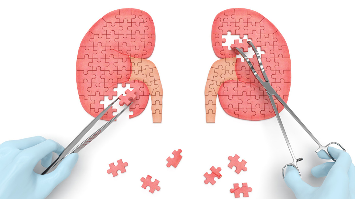 Πέτρες στα νεφρά: Επτά παράγοντες κινδύνου – Η αντιμετώπιση που σώζει