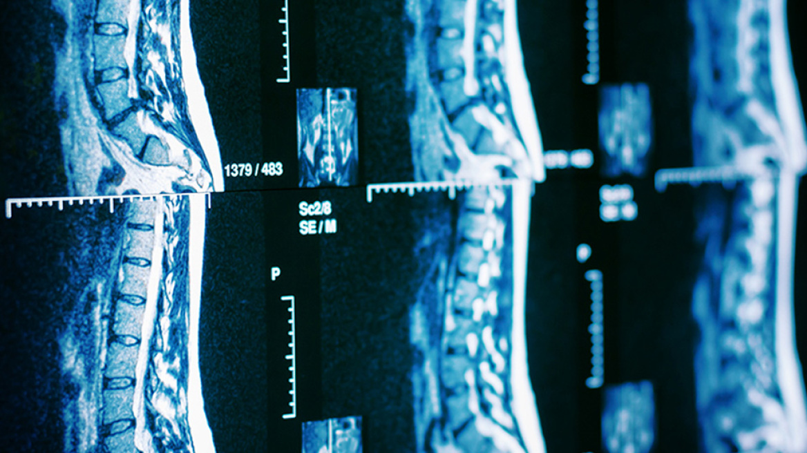 Ρομποτική χειρουργική σπονδυλικής στήλης: Τα πλεονεκτήματα