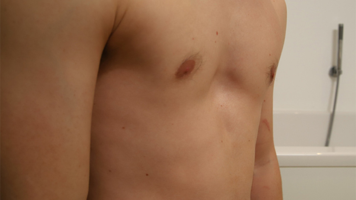 Σκαφοειδής Θώρακας: Τι είναι και πώς αντιμετωπίζεται