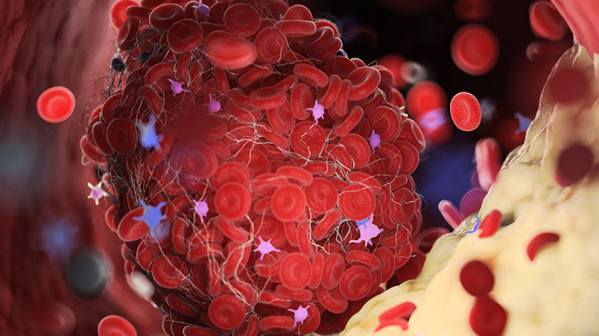 Διάγνωση των λιπιδίων που μπορεί να σώσει τη ζωή μας