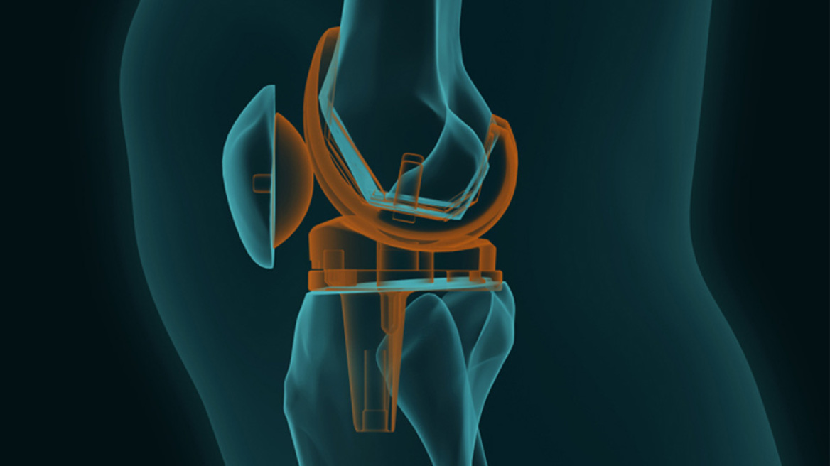Τι ισχύει για την αρθροπλαστική γόνατος και ισχίου