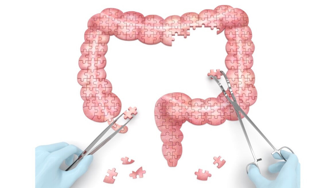 Καρκίνος Παχέος Εντέρου: Ο προληπτικός έλεγχος που σώζει ζωές