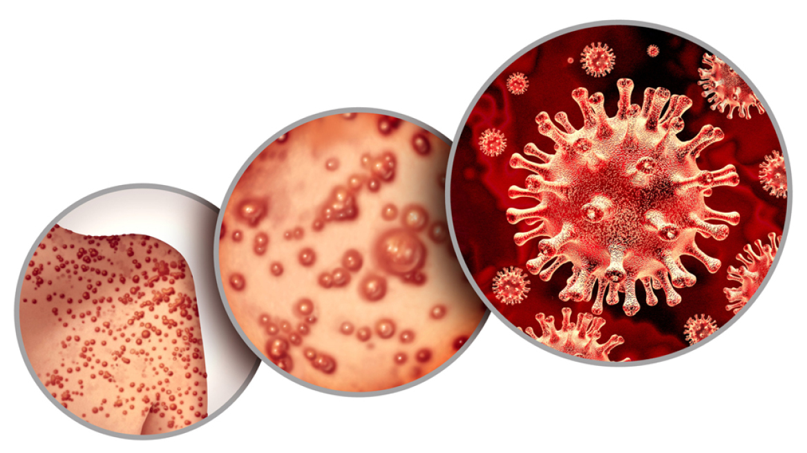 H ευλογιά των πιθήκων