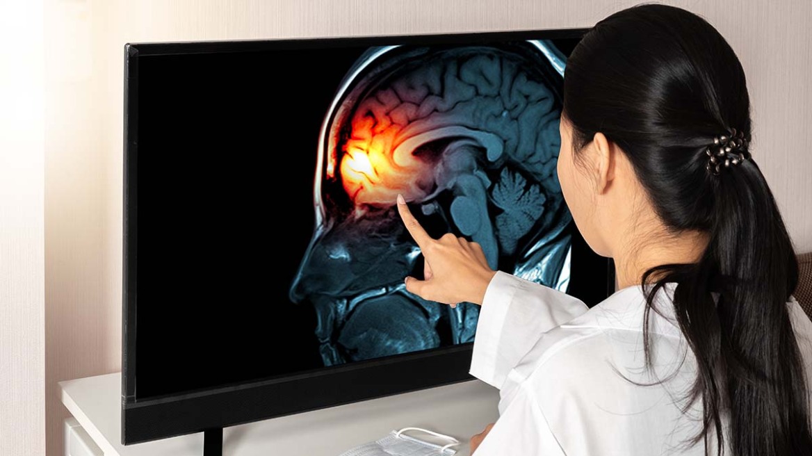 Νόσος Αλτσχάιμερ: Απλή εξέταση την εντοπίζει νωρίς