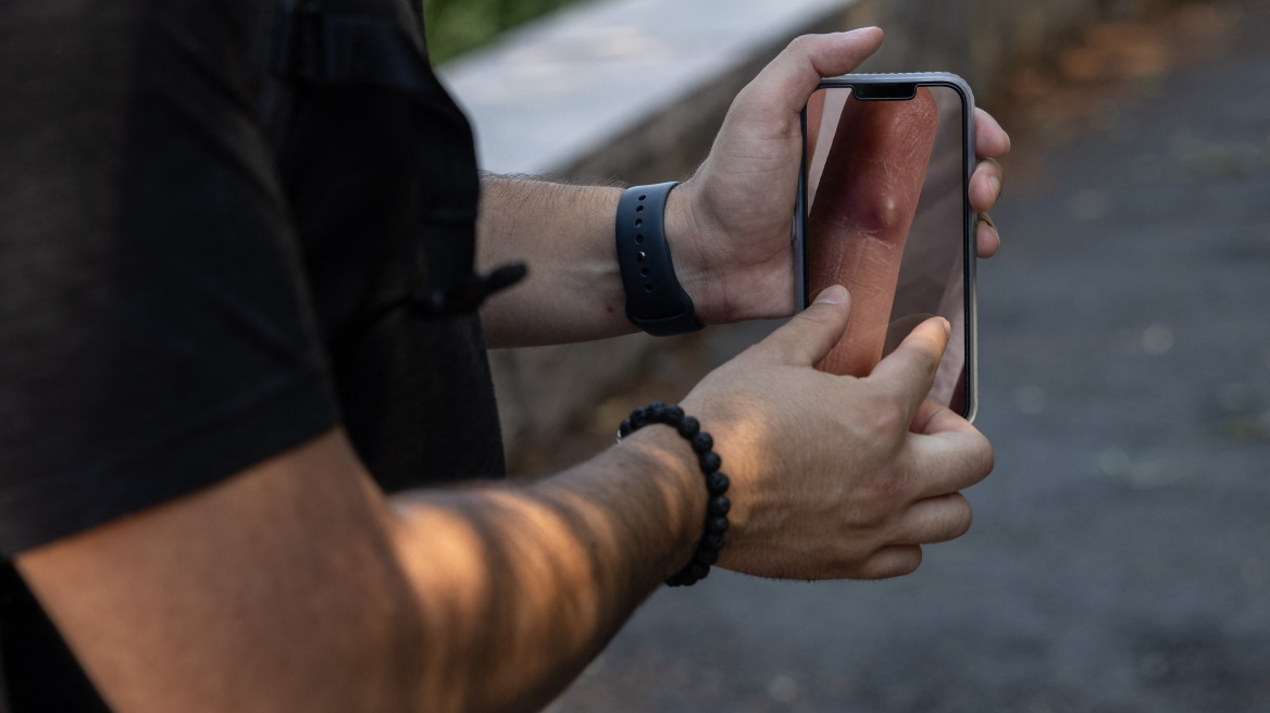 ΗΠΑ: «Ήταν οι χειρότεροι πόνοι που έχω βιώσει», λέει 26χρονος που πέρασε ευλογιά των πιθήκων