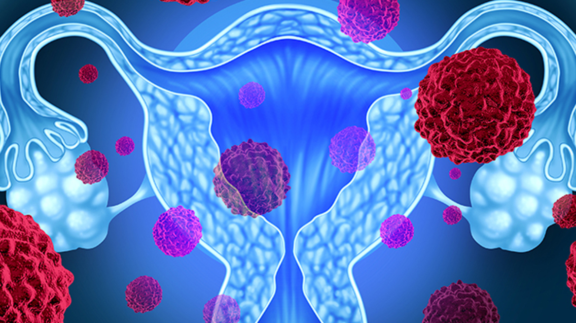 Καρκίνος του ενδομητρίου: Τα νεότερα δεδομένα για τη θεραπεία