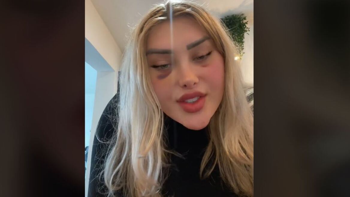 Μοντέλο του OnlyFans: «"Εξερράγη" το κεφάλι μου κατά τη διάρκεια πτήσης μετά από πλαστική επέμβαση»