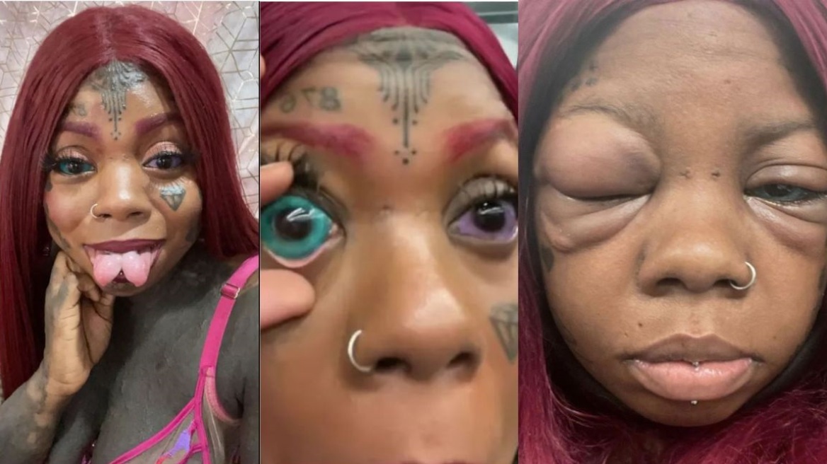 Έκανε τατουάζ στους βολβούς των ματιών της και τυφλώθηκε