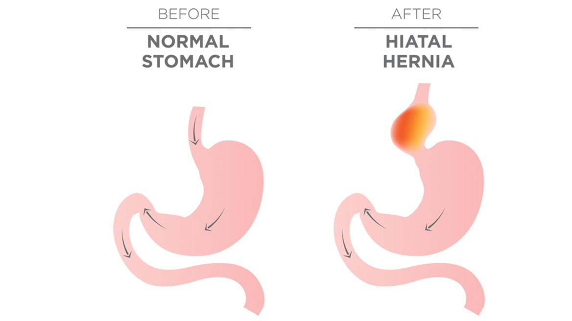 Αντιμετώπιση της διαφραγματοκήλης με ρομποτική χειρουργική