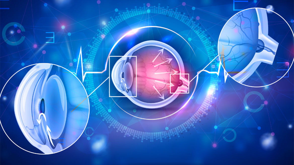 Γλαύκωμα: O «ύπουλος εχθρός» της όρασης