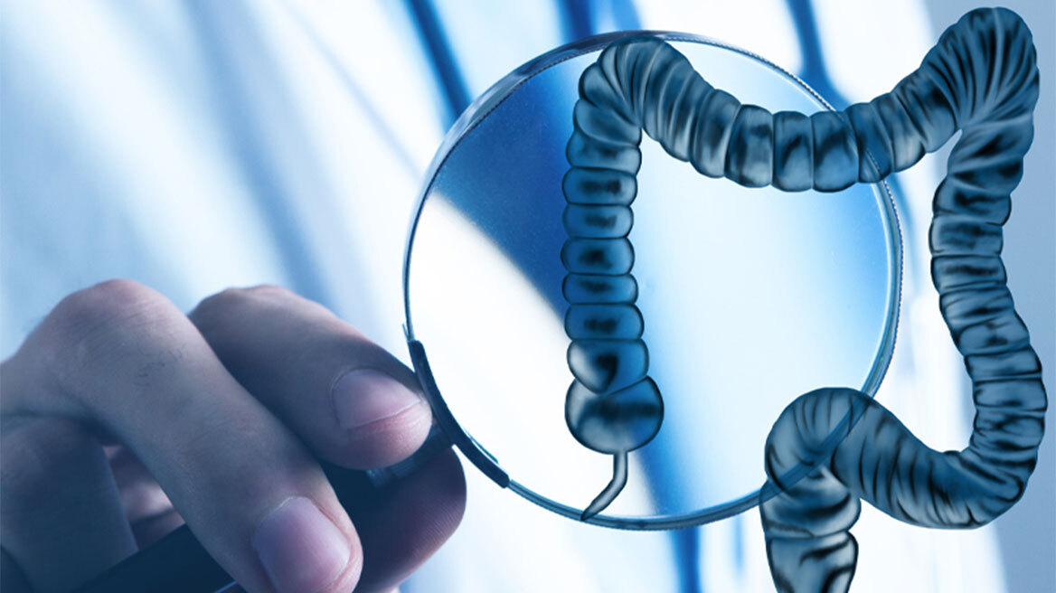 Εκκολπώματα Εντέρου: Τι είναι, πώς αντιμετωπίζονται