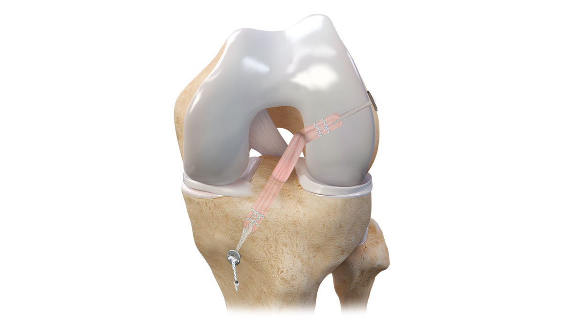 Ρήξη Πρόσθιου Χιαστού: Αντιμετώπιση με την τεχνική All Inside