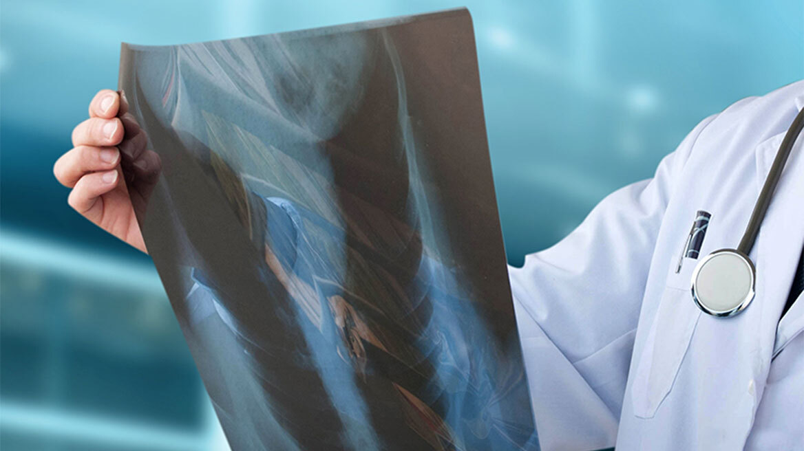 Πνευμονικός Όζος: Τι είναι και πώς αντιμετωπίζεται;