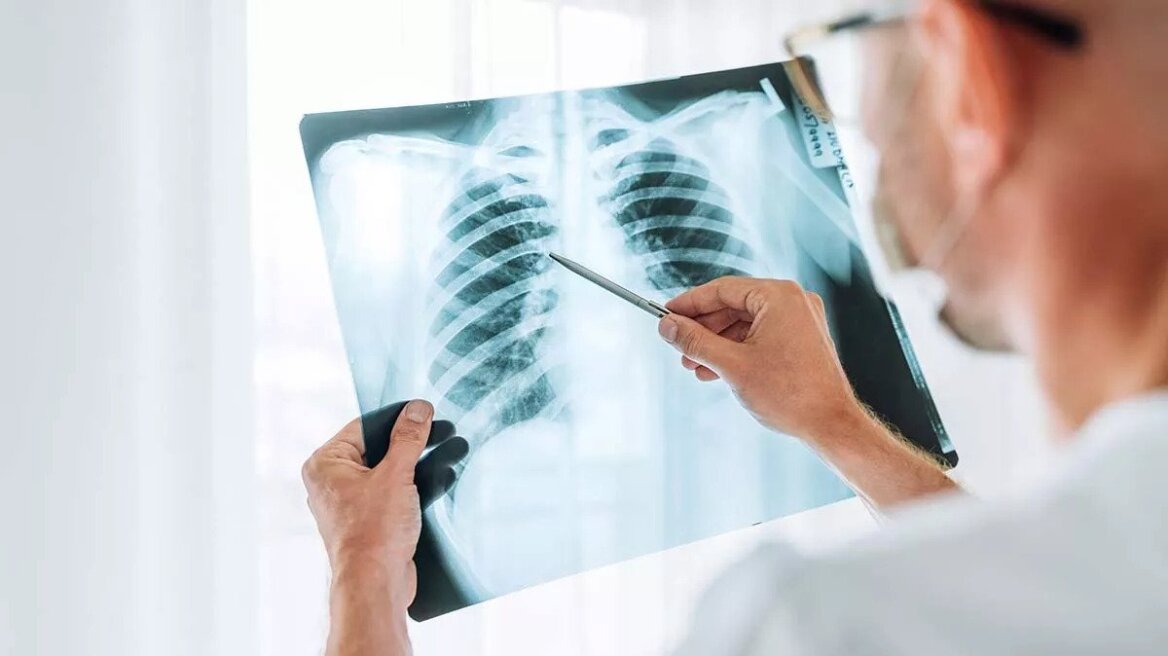 Όζοι Πνεύμονα: Πότε είναι «ύποπτοι» για καρκίνο – Η αντιμετώπιση