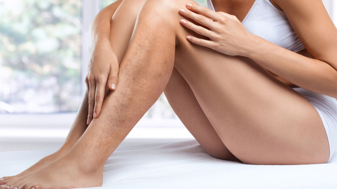 Καλοκαίρι: Θεραπευτική αντιμετώπιση κιρσών με ενδοαυλικό laser