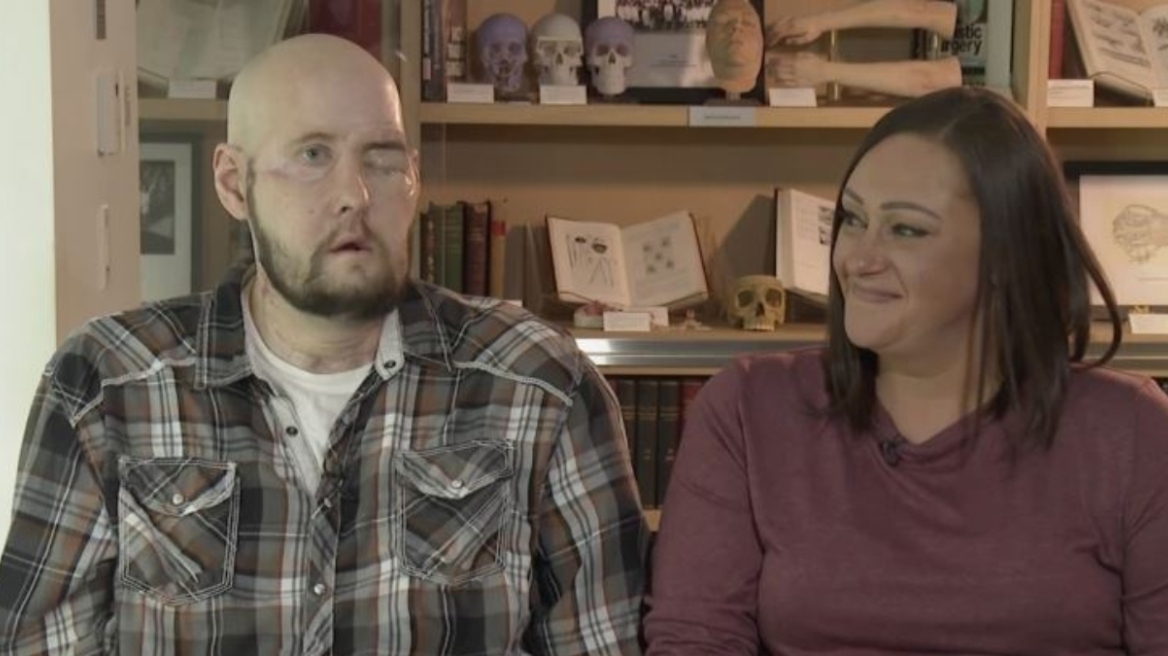 Νέα Υόρκη: Μεταμόσχευσαν για πρώτη φορά με επιτυχία ολόκληρο μάτι σε ασθενή - Δείτε φωτογραφίες