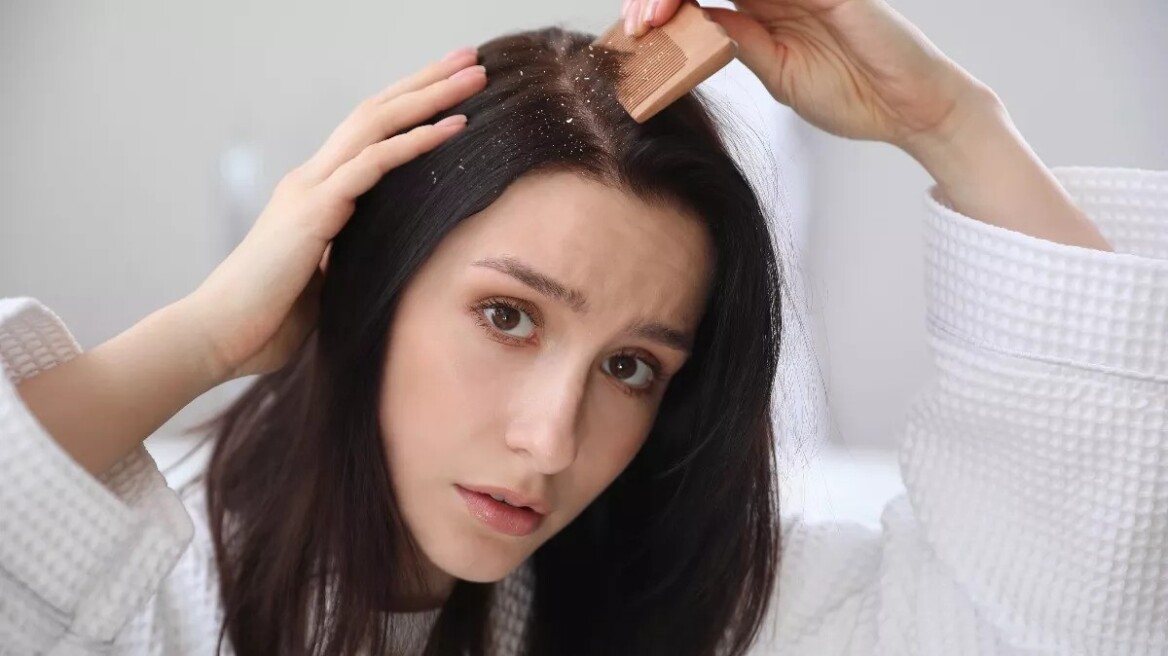 Πιτυρίδα: Γιατί χειροτερεύει όταν κάνει κρύο; Tips αντιμετώπισης