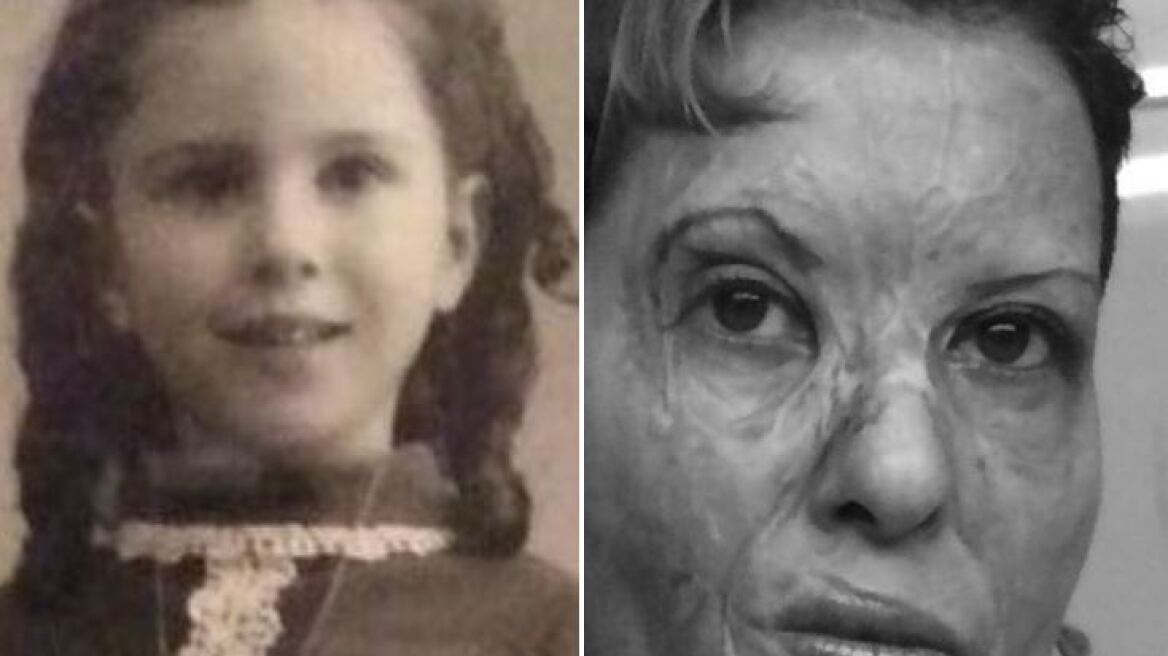 Η θωρακοχειρουργός Καλλιόπη Αθανασιάδη 26 χρόνια μετά το ατύχημα: «Να μη φοβόμαστε να είμαστε σημάδι αντίφασης»