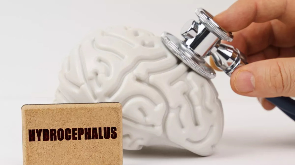 Υδροκέφαλος: Τα συμπτώματα στα παιδιά – Η αντιμετώπιση που προσφέρει λύση στους μικρούς ασθενείς
